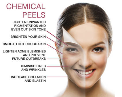 Chemical Peel for website