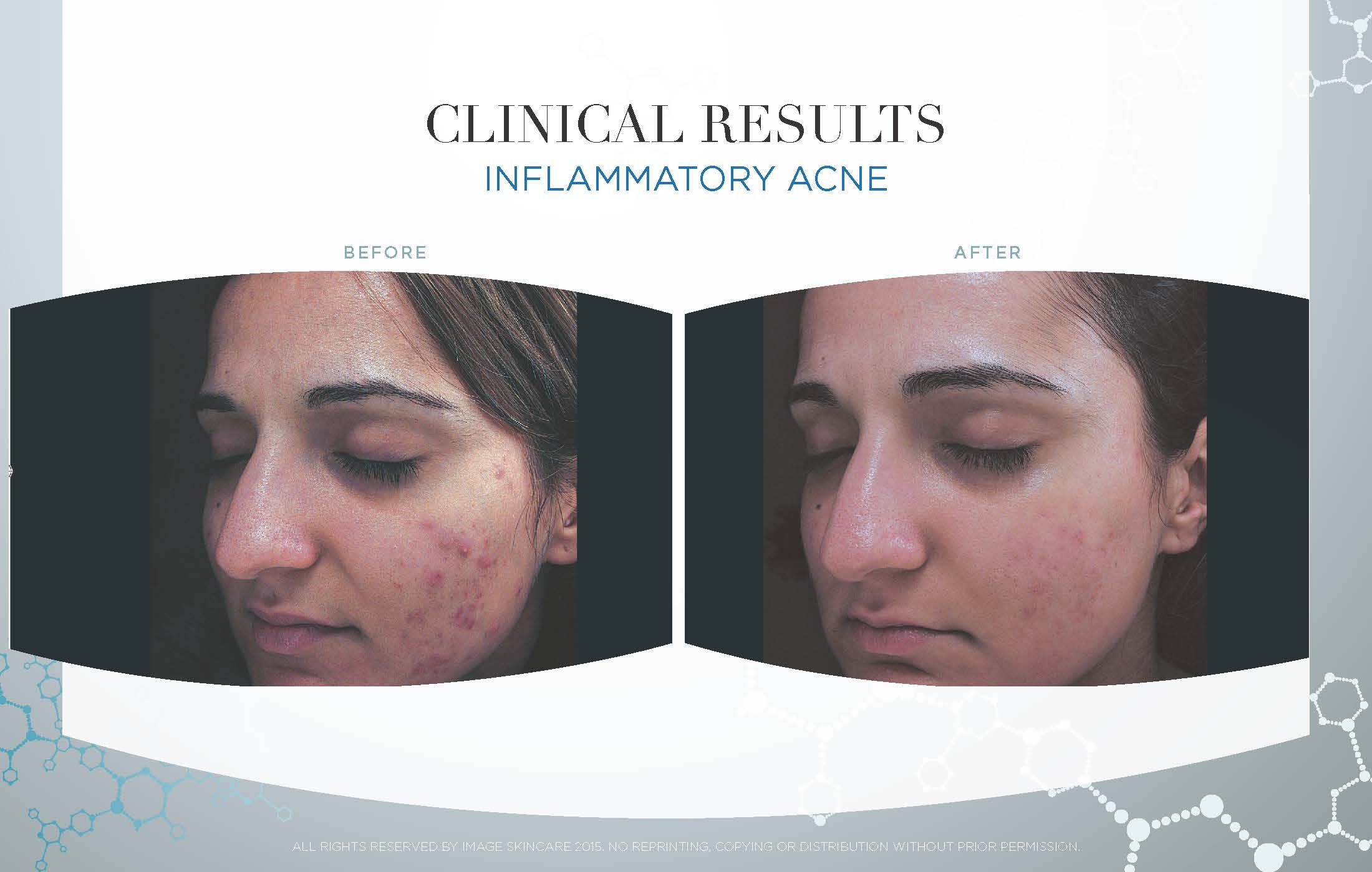Acne Lift Picture