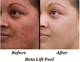 beta-lift-peel