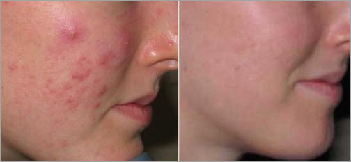 dermaplaning peel