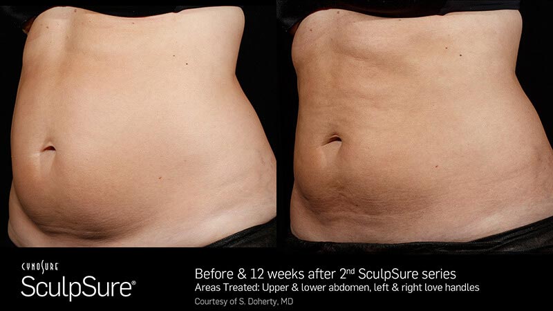 P_BA_SculpSure_Doherty_Core_2Tx_12Weeks_01_13_small-1_web