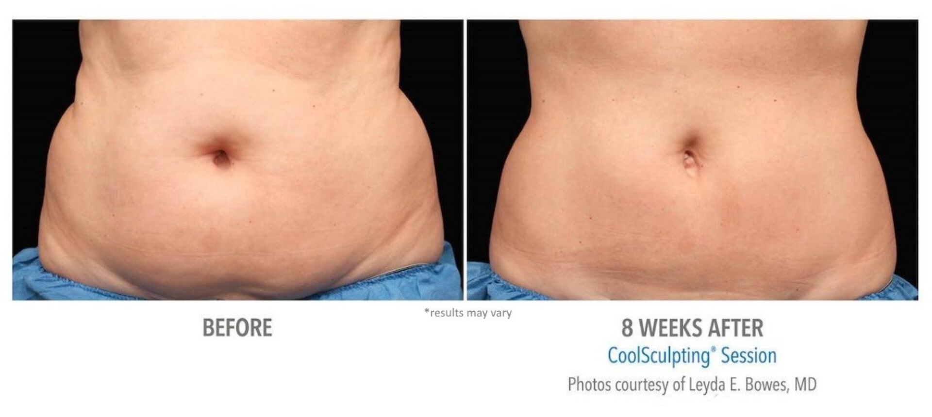 Sculptology-CoolSculpting-before-and-after-3