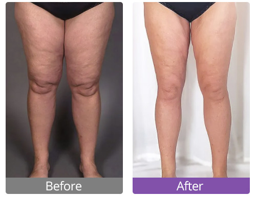 Thighs ultrasonic cavitation treatment effect comparison chart