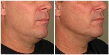 Ultherapy-Male-Face-Lift-Results-500x313