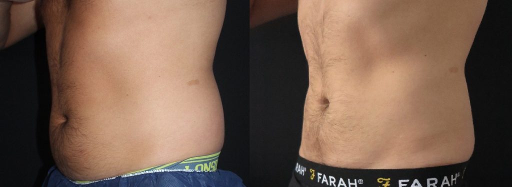 coolsculpting-abdomen-before-and-after-1024x375