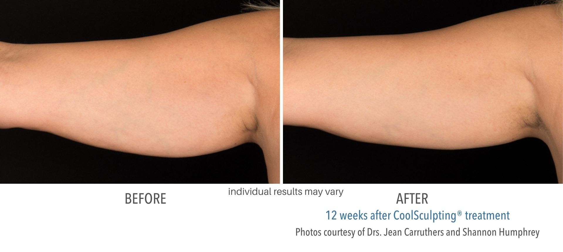 coolsculpting_before_and_after_conciergemedspa_5