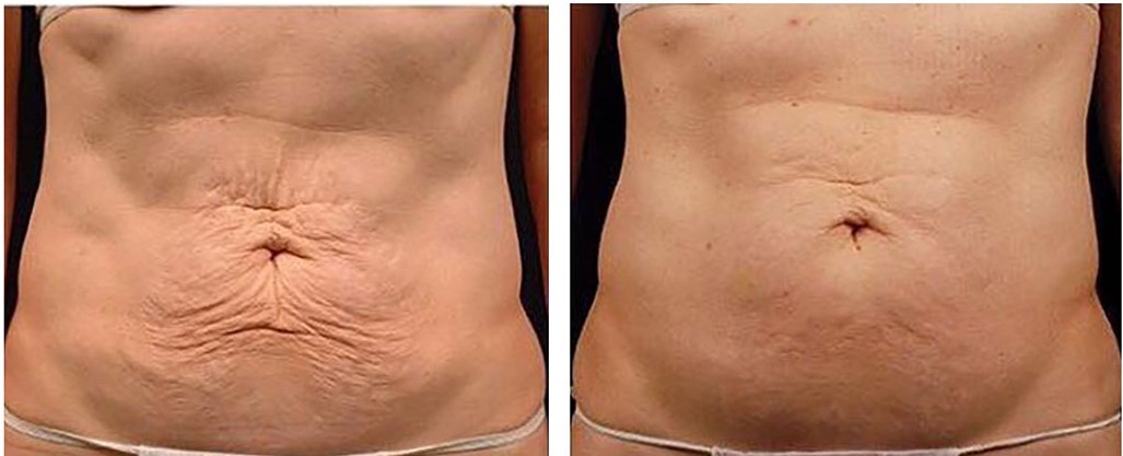 radio-frequency-results-1